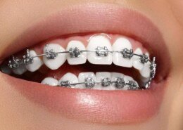 ClearCorrect: A Comprehensive Guide to Clear Aligner Therapy