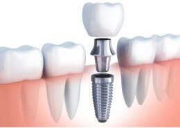 Tooth Replacement: Comprehensive Guide to Restoring Your Smile